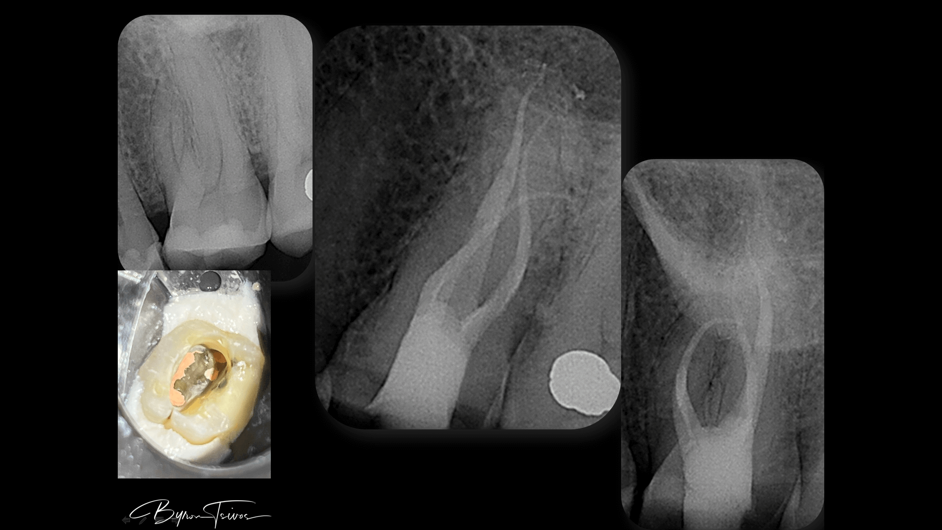 Complex Anatomy - Case 15
